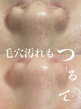 ピウ(piu)/【毛穴汚れ】ハーバルピーリング