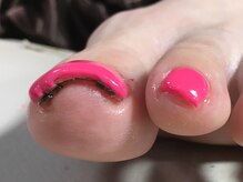 ビューティーサロンフルール(fleur)/巻き爪矯正