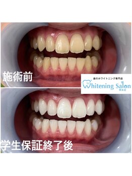ホワイトニングサロン 熊本店/【ホワイトニング施術例】
