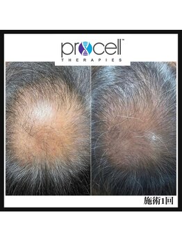 ヒルナム(Heal Nam)/プロセルセラピーズ　~頭皮~