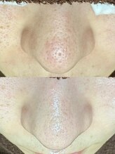 エクラ バイ シャンリィ(eclat by shanLy)/毛穴綺麗