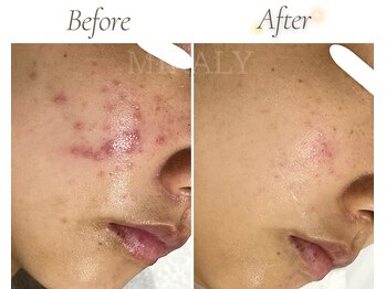 ミラリー(MIRALY)/頬赤みニキビケア7ヶ月(20代)