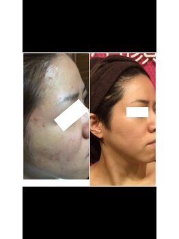 ココ(COCO)/ハーブピーリング/REVI/高知