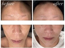 コリラ(CORILA)の雰囲気(エクソソーム×エラスチンでリフトアップ/たるみに効果◎)