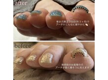 シロバコ(SHIROBAKO)/巻き爪矯正コース