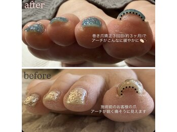 シロバコ(SHIROBAKO)/巻き爪矯正コース