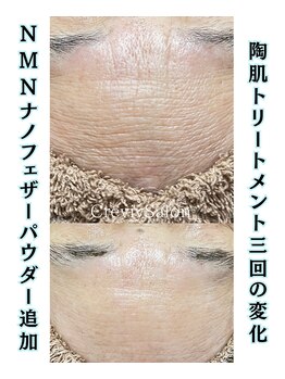 クレヴィー(Creviy)/陶肌トリートメント3回の変化