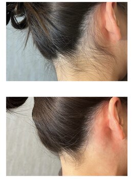 リリ(RiRi)/【脱毛】うなじ脱毛