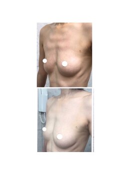 ソラ(sora)/バストアップ・バストケア症例★