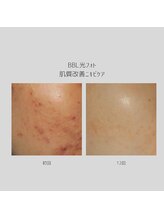 エモベーシック(e'MO BASIC)/BBL光フォト肌質改善ニキビケア
