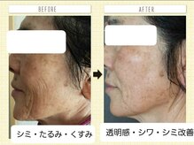 プライベートサロン 美月/シミケア・シワケアも一気に！