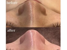 ボディベルム(BODY BELM)/ざらつき