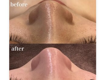 ボディベルム(BODY BELM)/ざらつき