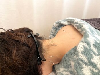天寿堂整骨院 天寿堂鍼灸マッサージ院の写真/慢性的な首・肩こりにお悩みの方はぜひ天寿堂へ！一人ひとりのお悩みに合わせた施術をご提供致します◎