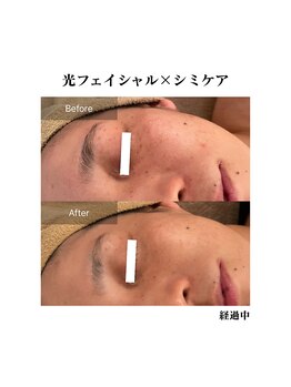 エムドット プラス(M DOT +)/シミケア×最新光フェイシャル