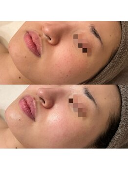 イリマレイサロン(iLima Lei SALON)/＼驚きの鎮静力／