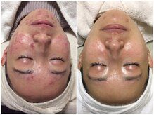 ビズビズ 天王寺店(bisebise)/ニキビ/毛穴開き黒ずみ角栓詰り