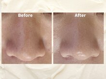 イエローウィーン(YELLOWEEN.)の雰囲気（頑固な黒ずみ毛穴も自然由来のピーリングで一掃！）