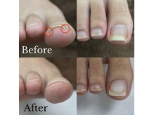 オーガニックネイルサロン プティ ボア(petit bois)の雰囲気（巻き爪矯正1回の変化☆ "ズキっ"と痛みや食い込みが今すぐ楽に☆）