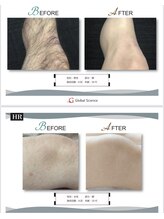 サンバイエム(#3/M)/メンズ脱毛