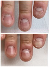 スマイルニコ(smile nico)/メンズ深爪矯正　長さ出し無し