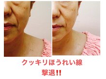 カブール 町田/ほうれい線撃退！