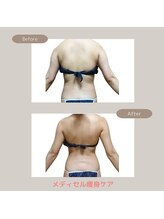 トレゾアスィス(Tresor sis)/痩身/ダイエット/筋膜リリース