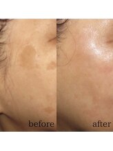 ユウユウ(YUYU)/純粋レチノールピール