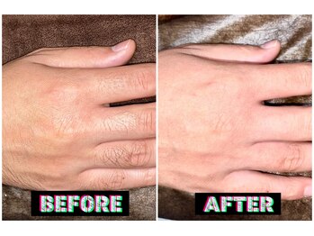 メンズスリーナインサロン(Men's ThreeNines Salon)/手の甲・指脱毛