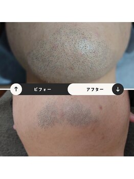 ジュゴン(Dugong)/髭脱毛（Before＆After）