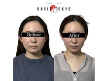 ネオオアシストウキョウ(ネオ OASIS TOKYO)の雰囲気（加工アプリいらずの輪郭へ【小顔/小顔矯正/美容鍼】）