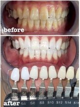 ホワイトニングミース 北千住店(MYS)/ビフォーアフター