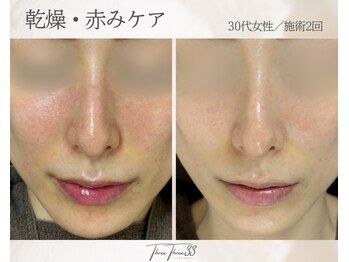 スリースリー(THREE THREE)/乾燥・赤みケア