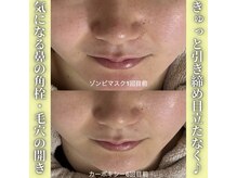 ハニエル(Haniel)/ゾンビマスク症例