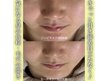 ハニエル(Haniel)/ゾンビマスク症例