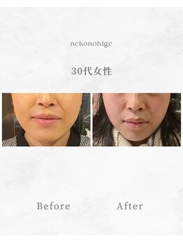 ねこのひげの写真/結婚式目前！美容鍼で憧れの小顔とむくみケアを！ブライダルで輝く私へ☆(39文字)