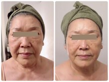 パルティール(PARTIR)/小顔マシン利用♪