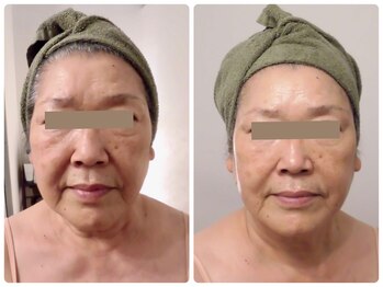 パルティール(PARTIR)/小顔マシン利用♪