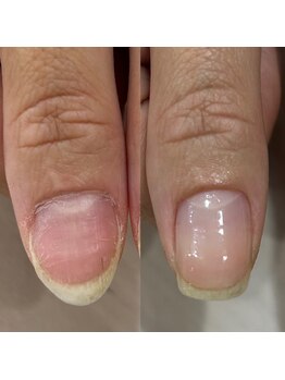 自爪育成ケアコース