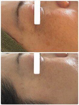 ビジュープラス 幸手店(Bijou+)/シワ・毛穴ケア