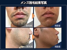 ゼロ 松阪店(ZERO)の雰囲気（しつこい髭脱毛もこの通り！結果出し専門店ならではの効果）