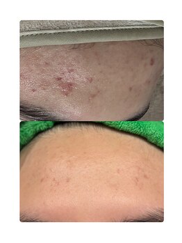 エヌクレアール(Ncrear)/ニキビも初回から効果を実感!