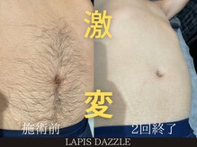 ラピスダズル(LAPIS DAZZLE)/全身脱毛☆途中経過