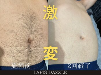 ラピスダズル(LAPIS DAZZLE)/全身脱毛☆途中経過