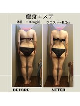 ムーン(MOON)/痩身エステbefore→after