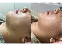 プリマプリート メンズ店の雰囲気（肌荒れも改善◎男性の肌悩みには一人一人に合う施術をご案内◆）