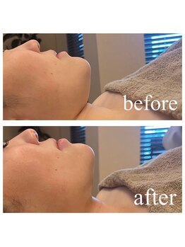 ディス イズ ミー エステティック(This is Me Aesthetic)/二重アゴ解消