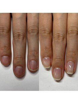 マニュコクーン(ManuCocoon)/爪育成 深爪 巻き爪 大阪市