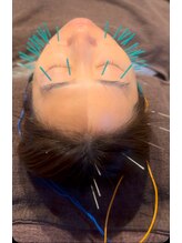 すぎ/小顔美容鍼