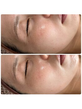 アネラ(ANERA)/毛穴撲滅！カーボキシー